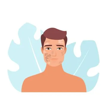 Man with melasma and hyperpigmentation Stock Illustration