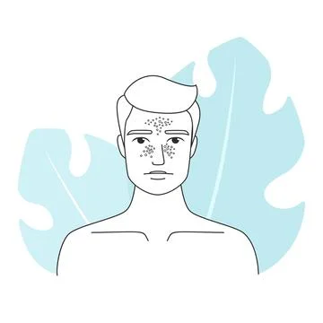 Man with melasma and hyperpigmentation Stock Illustration