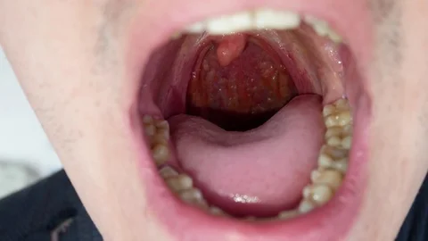 Man Opens the Mouth and Shows the Throat with Tongue and Tonsils Stock Footage 75869641
