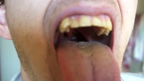 The Man Opens the Mouth and Shows the Throat with Tongue and Tonsils. Cavity Stock Footage 77167426