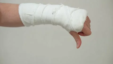 Man with plaster cast on arm. A broken a... | Stock Video | Pond5