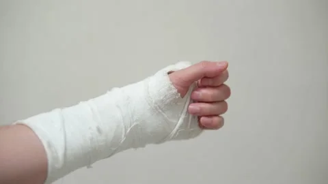 Man with plaster cast on arm. A broken arm in plaster. Stock Footage 234216751