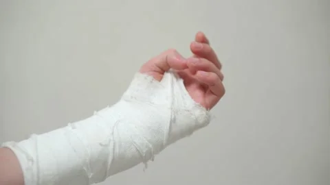 Man with plaster cast on arm. A broken a... | Stock Video | Pond5