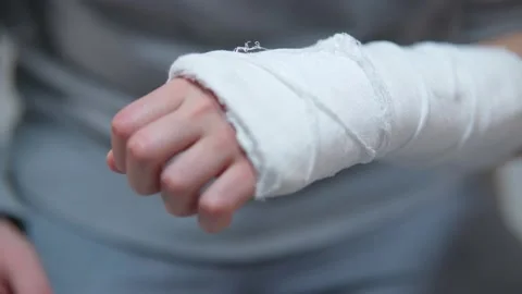 Man with plaster cast on arm. The difficulty of self-movement of the hand at a Stock Footage 234050472