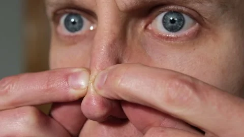 Man pressing red pimple with fingers. A guy squeezes a pimple. Inflammation on Stock Footage 305242563