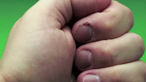 Man, problem hand with gnawed nails in poor condition on green background. The Vídeo Stock 104472616