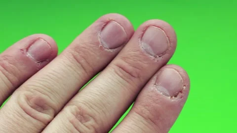 Man, problem hand with gnawed nails in poor condition on green background. The Vídeo Stock 104473970