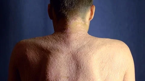 Man with problematic skin showing his back indoor, hronic psoriasis. 스톡 동영상 95049158