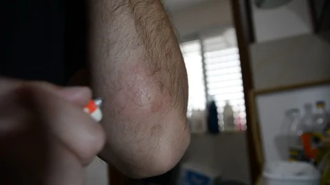 Man processes an insect bite on his hand Stock-Footage 128621472