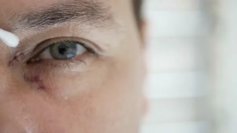 A man processes stitches on a wound after surgery Stock Footage 150666466