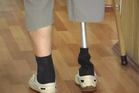 Man with prosthetic Stock Footage 12351604