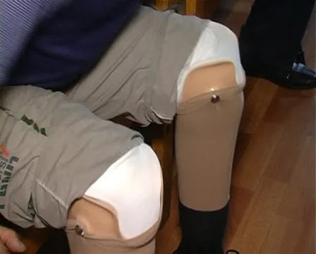 Man with prosthetic Stock Footage 12351618