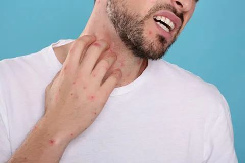 Man with rash suffering from monkeypox virus on light blue background, closeu Stock Photos
