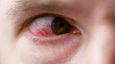 A man with a red, sore eye. An infection during illness struck the eyes. Stock Footage 152844352