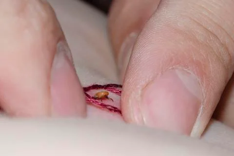 Man removing a tick from skin Stock Photos