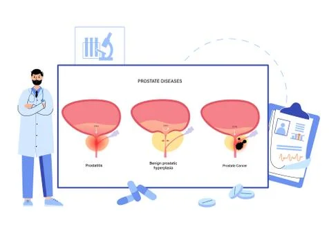 Man Reproducive System Problems Stock Illustration