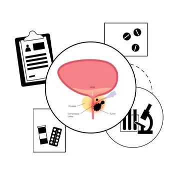 Man Reproducive System Problems Stock Illustration