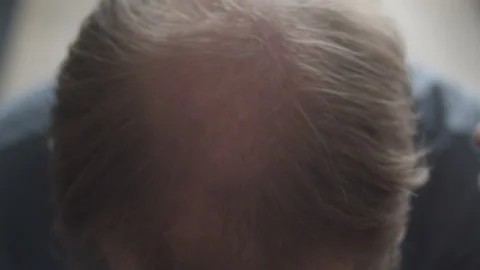 Man rubbing hand over his bald spot in his hair - front view Stock Footage 150190548