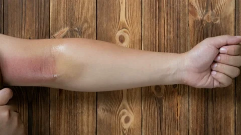 Man scraping his arm by a copper scratcher which is a traditional Chinese med Stock Footage 165164300