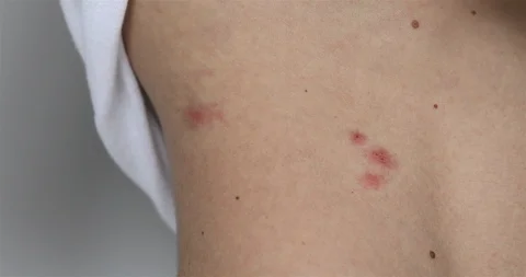 Man Scratch The Itch With Hand, Red Spots On The Waist Stock Footage 123703821