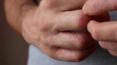 The man scratches his hands. Very itchy fingers, psoriasis. Stock Footage