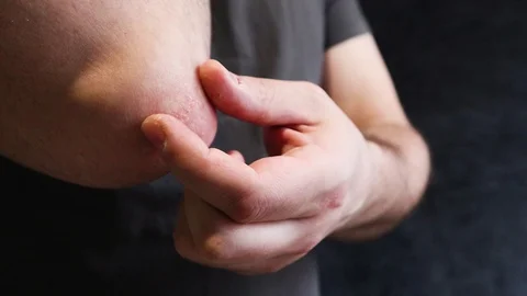 A man scratches a rough patch of skin on his elbow, a seasonal skin problem. 스톡 동영상 123536610