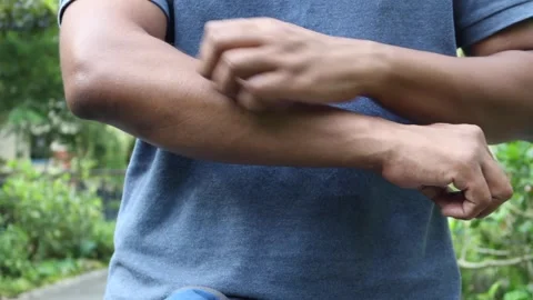 Man scratching arm due to itchy skin, outdoor close-up. 스톡 동영상 332626202