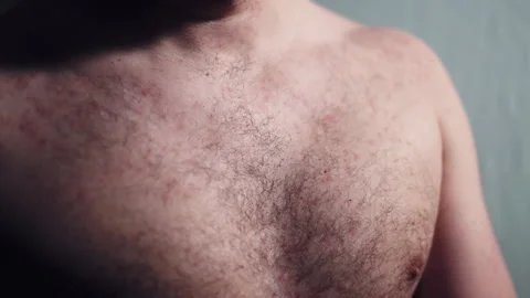 Man scratching his chest with hand because of small red pimples causing strong Stock-Footage 303581259