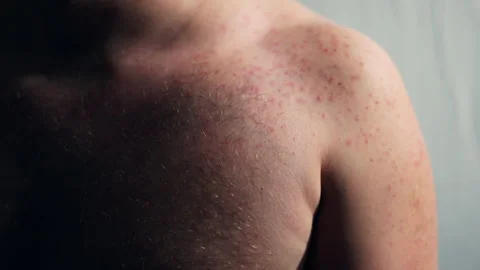 Man scratching his chest with hand because of strong itchy skin reaction, lots Stock-Footage 303662969