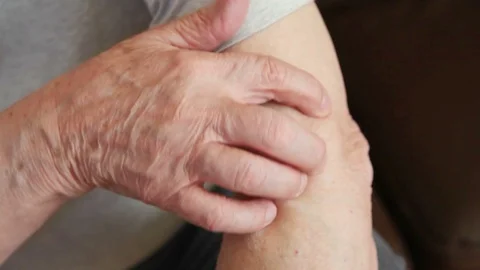Man scratching irritation on his arm Stock Footage 88712254