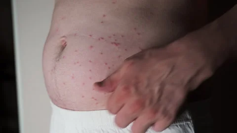 The man is scratching the pimples on his stomach. They itch a lot, Stock Footage 244453207