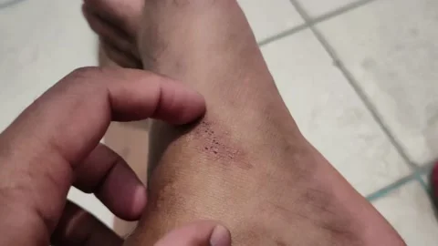Man scratching a red rash on the soles of his feet at close range Allergies and Stock Footage 164645292