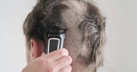 Man is shaved bald before surgery. Concept effects chemotherapy, need, health 動画素材 255949898