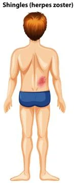 A Man with Shingles at the Back Stock Illustration