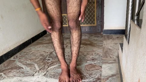 Man Showing Bow Legs Problem, Genu Varum Leg Deformity Demonstration 스톡 동영상 315386979