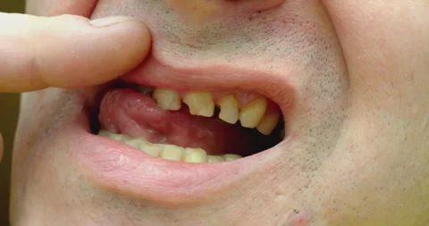 Man showing rotten and broken teeth problem Stock Footage 327588226