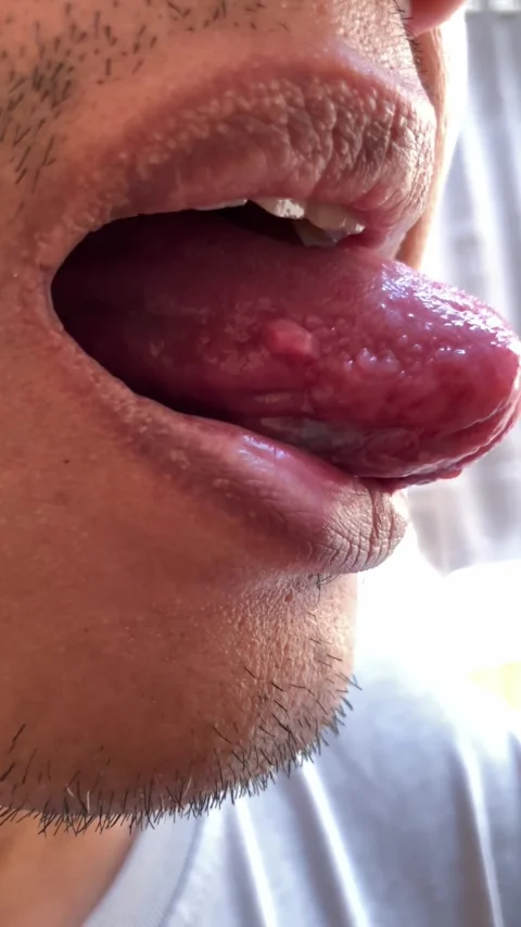 A Man Shows A Lump On The Side Of His Tongue Stock Footage 342578672