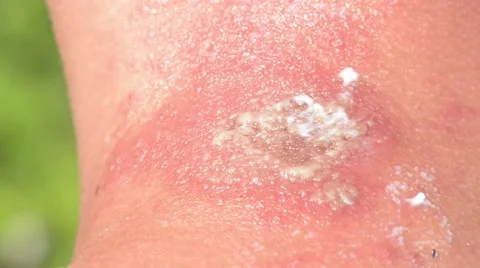 Man With Sickness, Swollen Pus Stock Footage 40341292