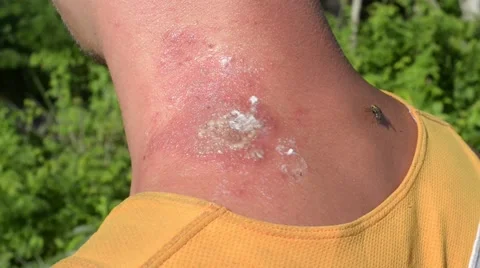 Man With Sickness, Swollen Pus Stock Footage 40341296