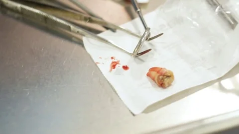 Man siting in dentist chair, pull up a tooth Stock Footage 81179808