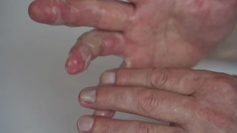 A man smeared ointment on his hand with a second-degree hot water burn. The skin Stock Footage 155462402