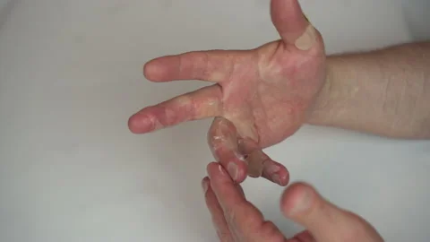 A man smeared ointment on his hand with a second-degree hot water burn. The skin 库存影片 155462418
