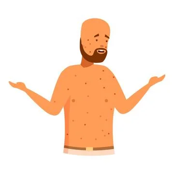 Man suffering from chicken pox showing symptoms with open arms Stock Illustration