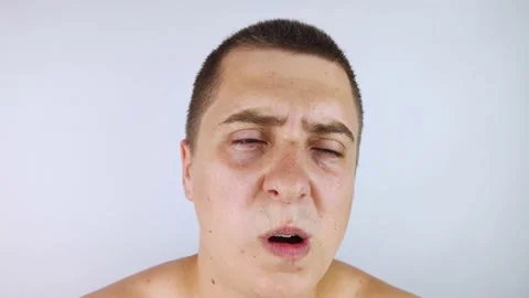 A man with sweating on his face is looking at the camera. Sweat gland problems.  Stock Footage 158285546
