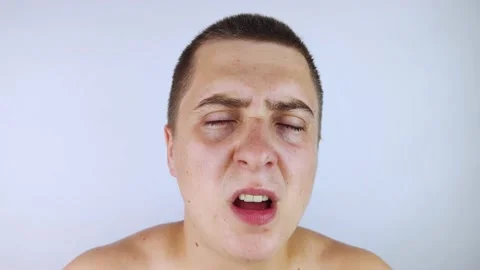 A man with sweating on his face is looking at the camera. Sweat gland problems.  Video stock 158285703