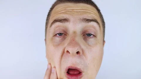 A man with sweating on his face is looking at the camera. Sweat gland problems.  Video stock 158285814