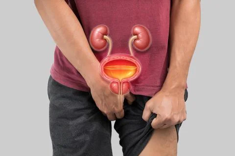 Man with Symptoms of Benign Prostatic Hyperplasia (BPH) or Enlarged Prostat.. Foto stock