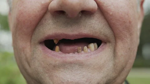 The man teeth fell out, yellow and black teeth hurt. Poor teeth condition Stock Footage 131220794