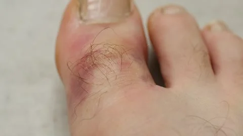 Man toe with bruises and nail fungus on light background Stock Footage 296748266
