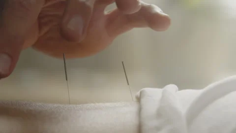 A Man Touching Acupuncture Needles Stock Footage 275049714